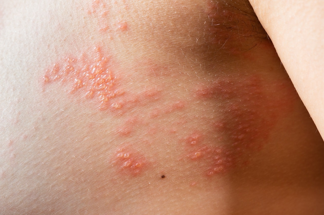 Coping with Shingles: A Comprehensive Guide to Shingles