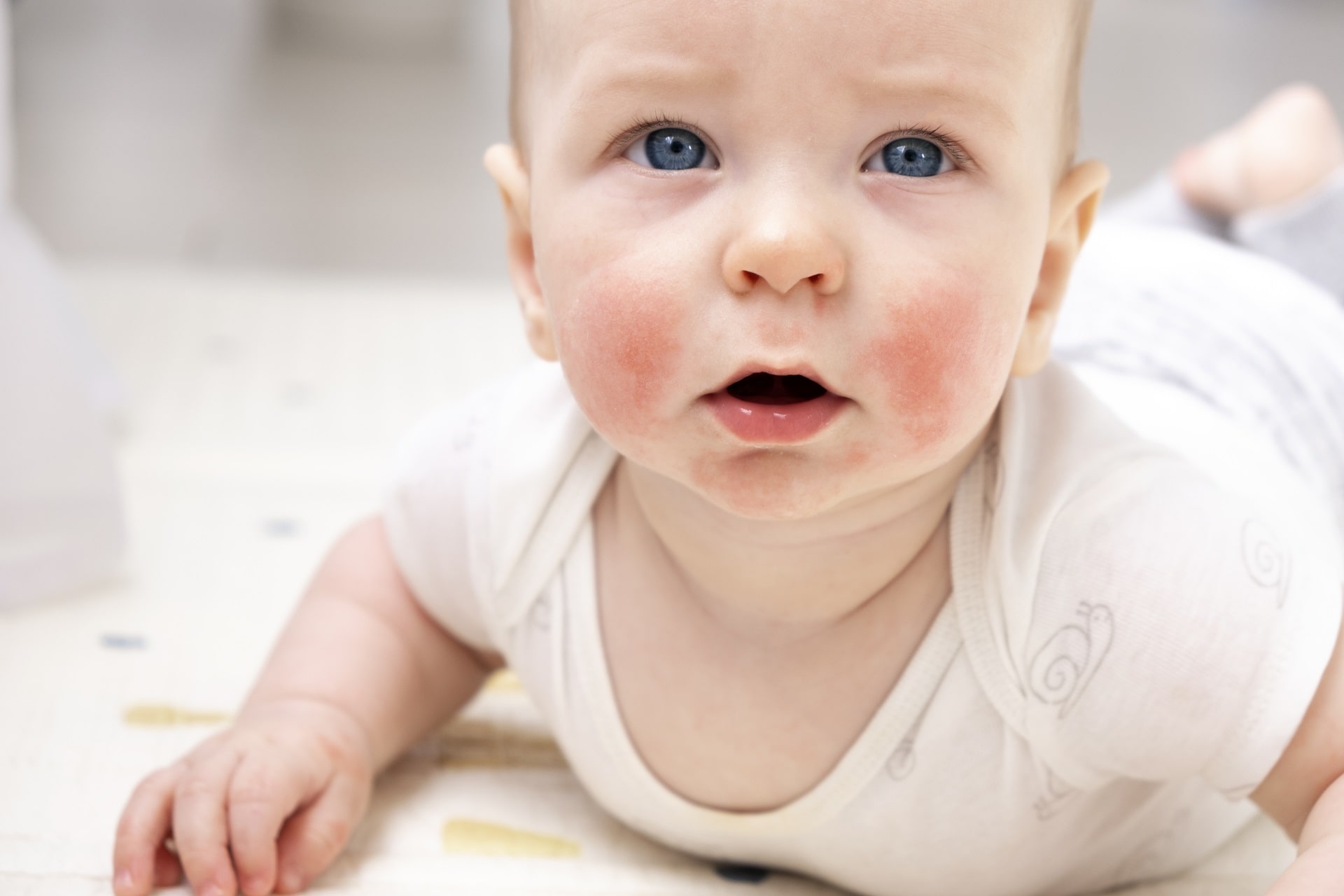 Skin Allergy in Infants