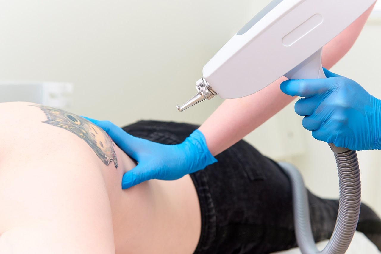 How is tattoo removal done?