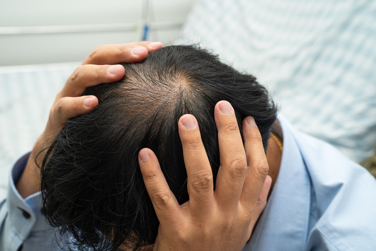 What causes male pattern hair loss and how is it treated?