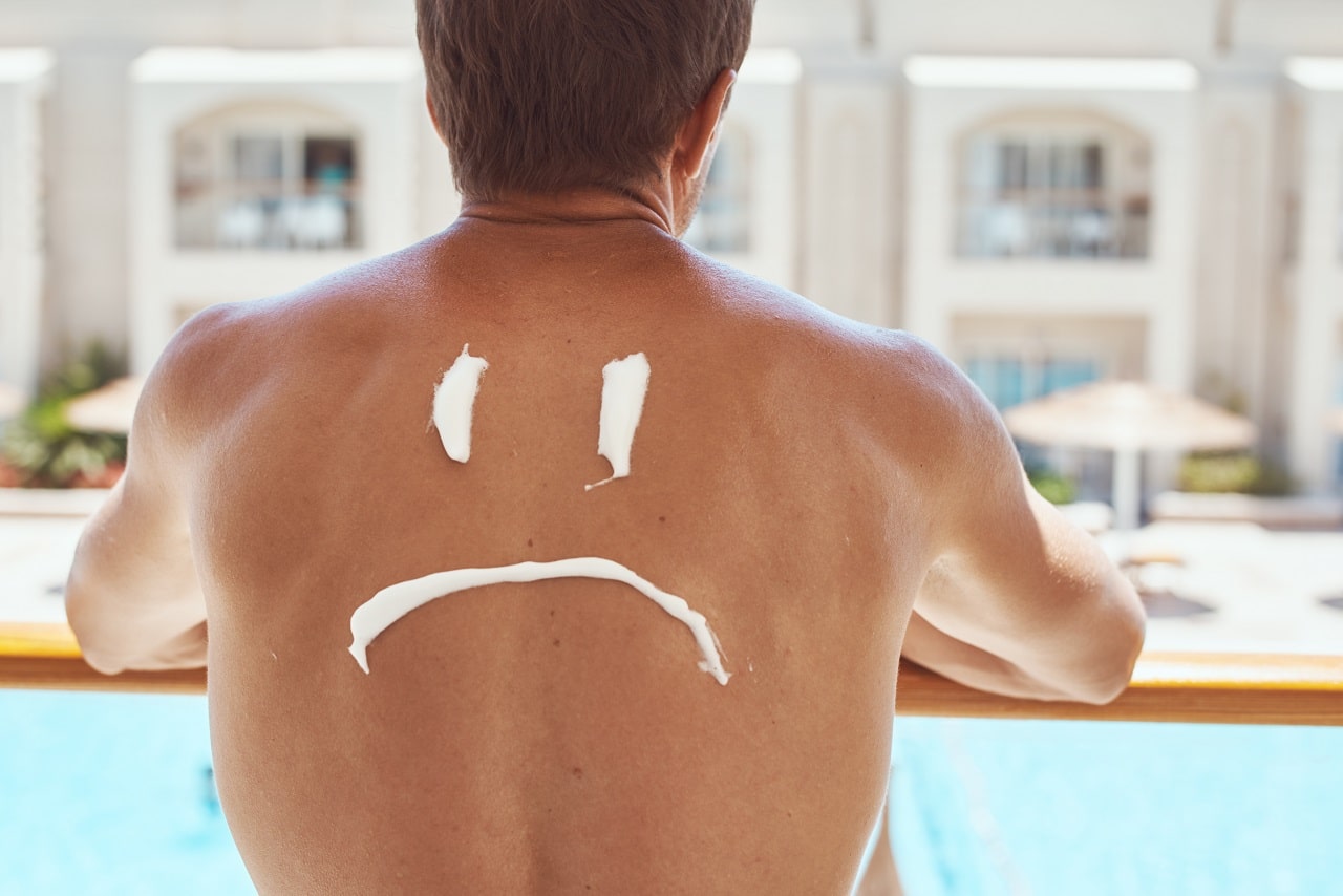 What is sunburn, and how is it treated?