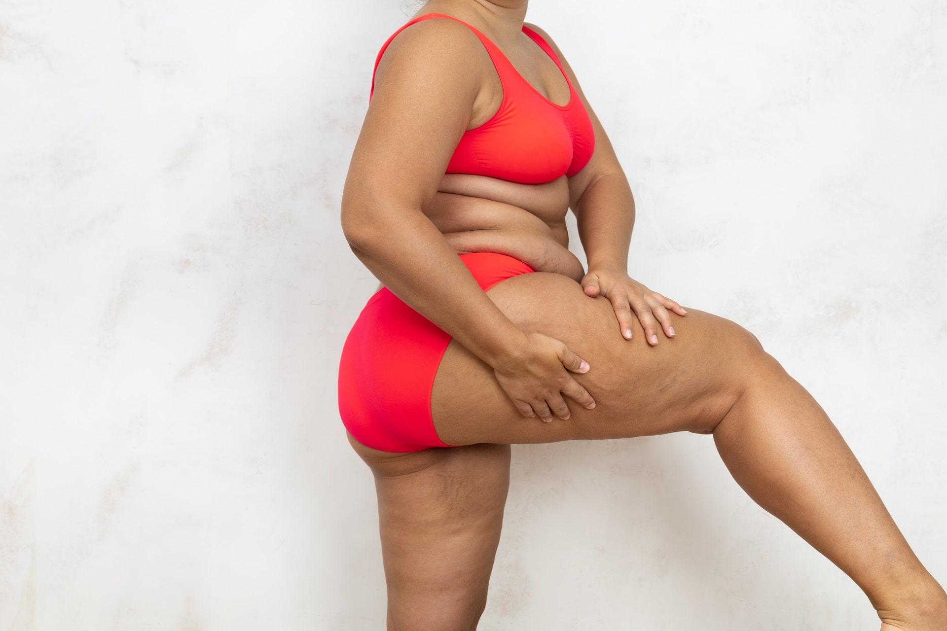 What is Cellulite and How Does It Go Away?