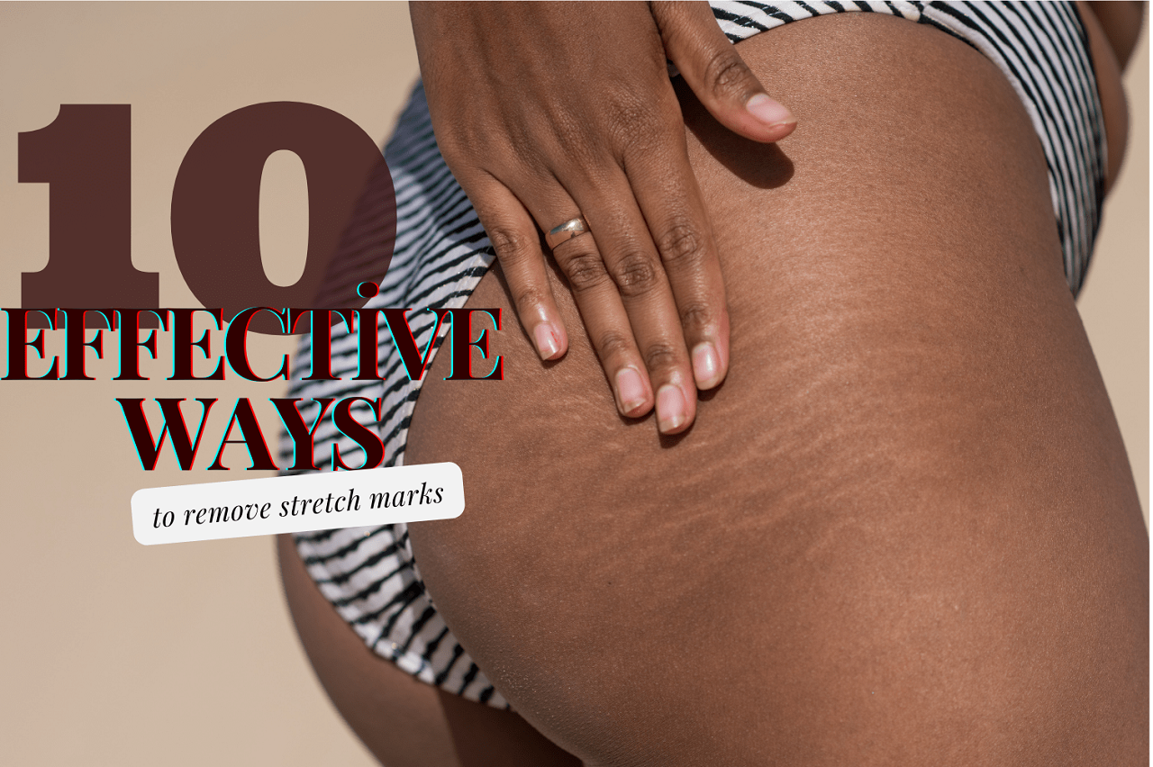 10 effective ways to remove stretch marks