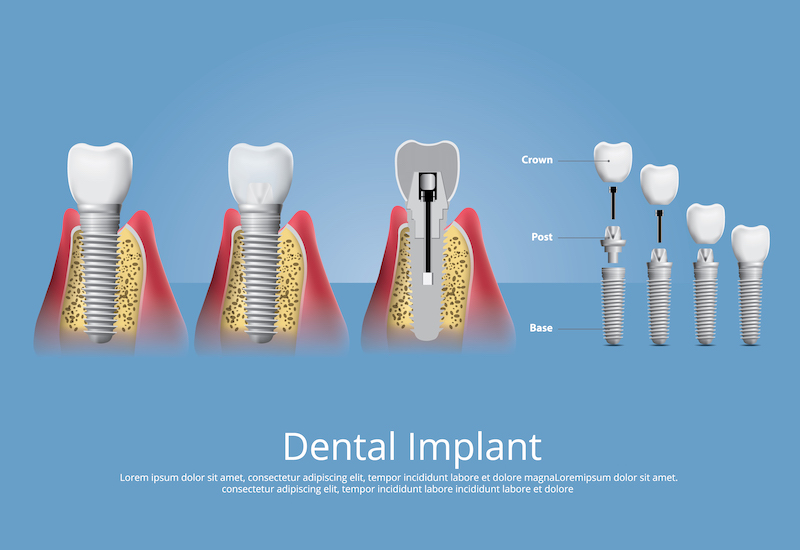 What is an Implant? How to Get an Implant in Turkey?